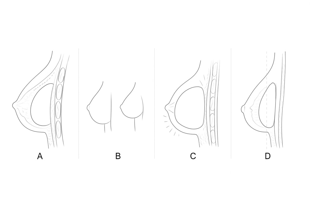 Häufige Brustimplantat-Irrtümer – prägnant erklärt
